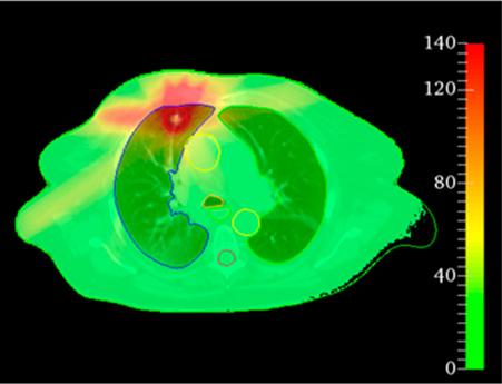 Farbcodierte CT-Querschnittaufnahme des Brustkorbs mit geplanter Strahlendosisverteilung für einen Lungentumor; deutlich erkennbar sind Lungenstrukturen, Zielvolumen und angrenzende Risikoorgane. 